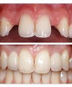 Image result for Lateral Incisor Build Up