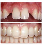 Image result for incisorio