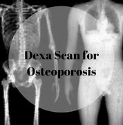 Image result for Dexa Scan Osteoporosis