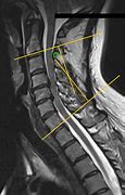 Image result for Cervical Spine MRI Thecal Sac