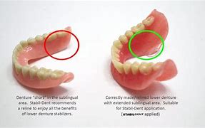 Image result for Bottom Dentures