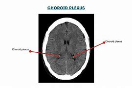 Image result for Choroid Plexus CT