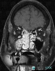 Image result for Inverted Papilloma Sinus