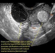 Image result for Hemorrhagic Ovarian Cyst Ultrasound