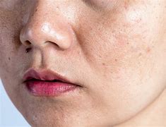 Image result for Skin Discoloration On Face