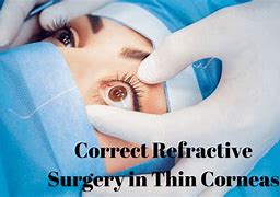Image result for Refractive Corneal Surgery