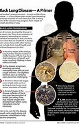 Image result for Black Tar in Lungs