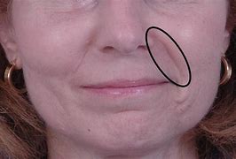 Image result for Lines On Side of Mouth