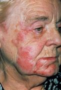 Image result for Red Rash On Face Adults