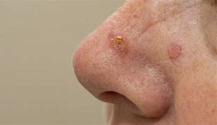 Image result for Inflamed Actinic Keratosis