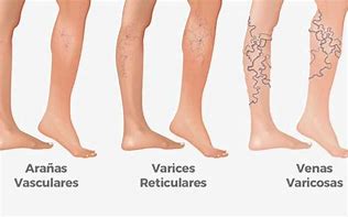 Image result for Varices Sintomas