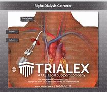 Image result for Dialysis Chest Catheter