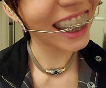 Image result for Metal Braces Teeth Headgear