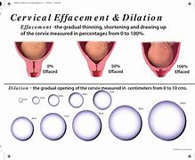 Image result for Purple Line Cervical Dilation