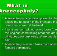 Image result for Born without a Brain Anencephaly