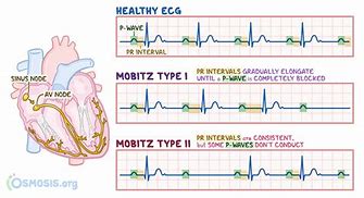 Image result for Mobitz Type 1 ECG Trace