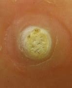 Image result for How to Remove Plantar Warts On Feet