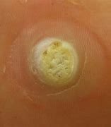 Image result for Black Seed Foot Wart