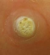 Image result for Planters Wart On Heel