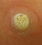 Image result for Plantar Wart Core Removal