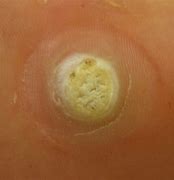 Image result for Wart Core