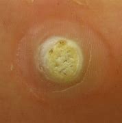 Image result for Wart or Papilloma