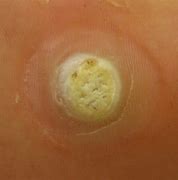 Image result for Viral Wart On Finger