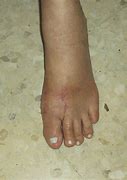 Image result for Orthopedic House Shoes for Men