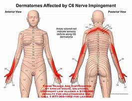 Image result for C5 C6 Nerve Root Impingement Symptoms