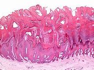 Image result for Types of Warts On Groin Folds