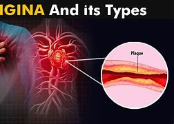 Image result for angina