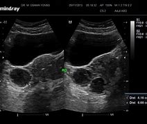 Image result for Hemorrhagic Cyst On Ovary
