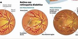 Image result for Problemas En La Retina