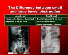 Image result for Apple Core Sign and Bowel Obstruction