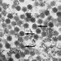 Image result for Human Papillomavirus Images