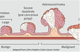 Image result for Colon Cancer Polyps