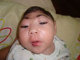 Image result for Anencephaly Defect
