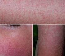 Image result for 5th Disease Rash Pictures