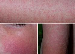 Image result for Fifth Disease Skin Rash