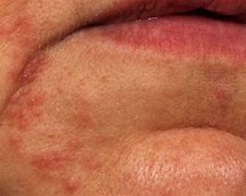 Image result for Red Rash around Mouth