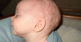Image result for Scaphocephaly