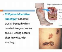 Image result for Ecthyma Differentials