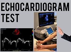 Image result for Echocardiogram Preparation