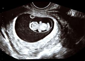 Image result for 9 Weeks 5 Days Ultrasound