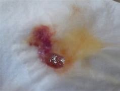 Image result for Blood in Phlegm