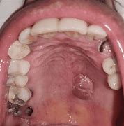 Image result for Squamous Papilloma Oral Lesion