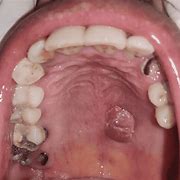 Image result for Squamous Papilloma of Palate