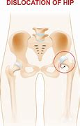 Image result for Dislocated Pelvis