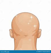 Image result for Hair Loss Cartoon