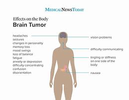 Image result for Brain Stem Tumor Symptoms